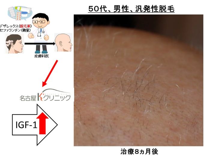 円形脱毛症　病院